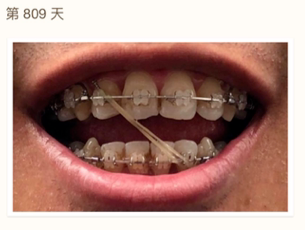 北京口腔医院正畸看牙记