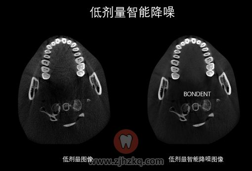 伯爵CBCT怎么样好在哪里？