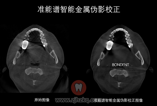 伯爵CBCT怎么样好在哪里？