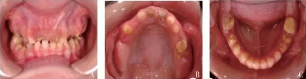 刘天爽教授17岁“无牙”女孩牙齿修复案例