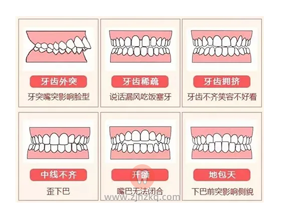 咬合不正图片