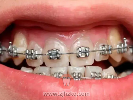 杭州矫正牙齿金属自锁和普通价格对比是多少？