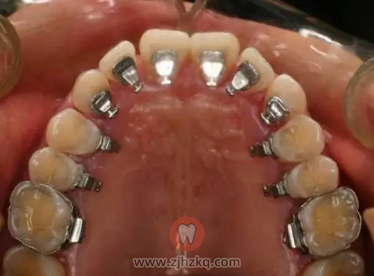 杭州舌侧矫正牙套科普