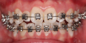 牙齿正畸不按时复诊会有哪些问题？