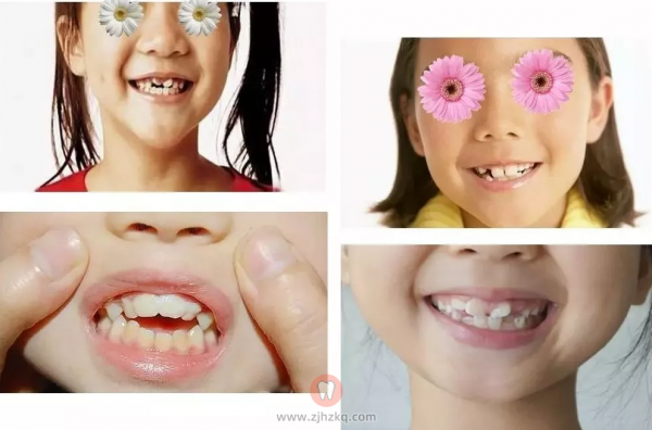 儿童牙齿畸形图片