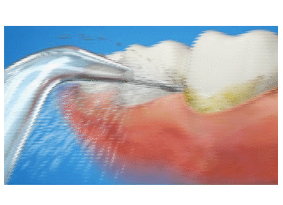 洗牙会导致牙缝变大吗？