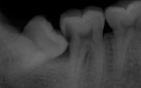 阻生智齿尽头牙图片