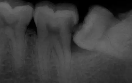 阻生智齿尽头牙图片