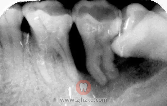 阻生智齿尽头牙图片