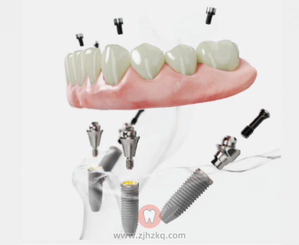杭州全口满口牙种植价格一般多少钱？