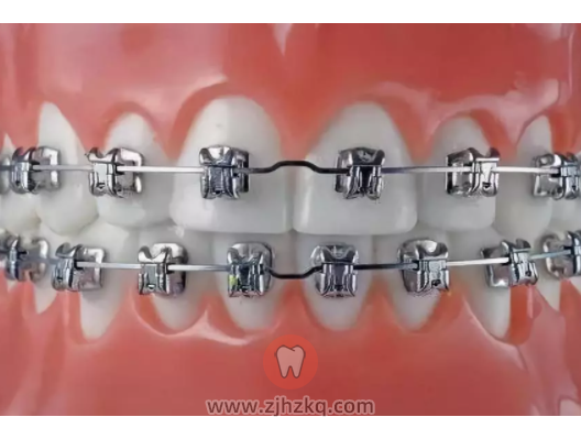 普通钢丝托槽矫治器图片