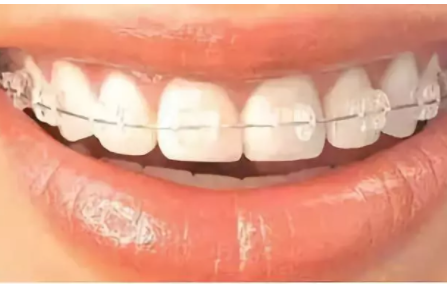 透明陶瓷托槽矫治器图片