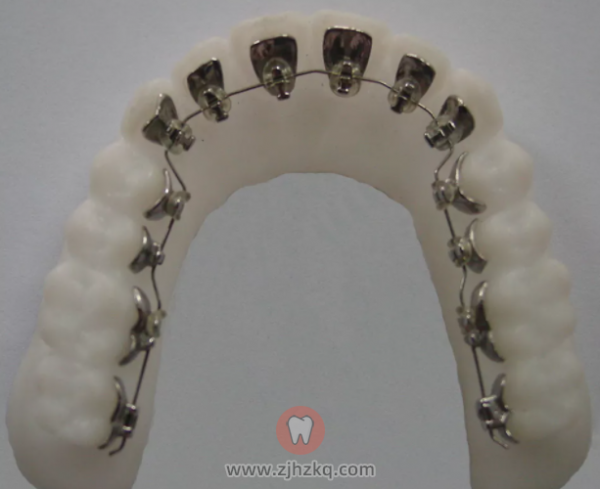 舌侧矫治器图片
