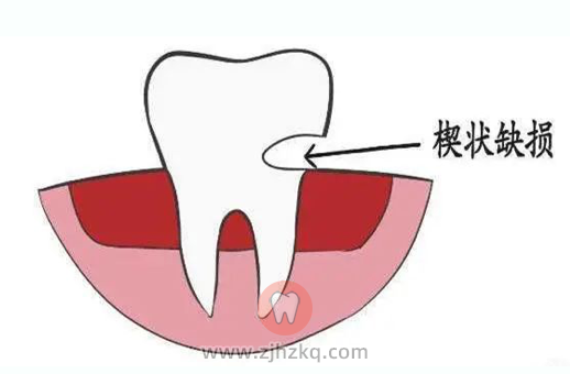 楔状缺损有什么症状？