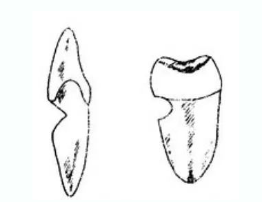 楔状缺损是什么原因导致的？