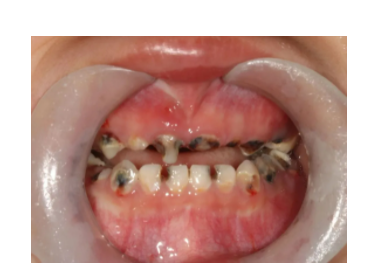 乳牙烂了一个洞引发骨髓炎