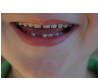 滯留乳牙需要拔吗?