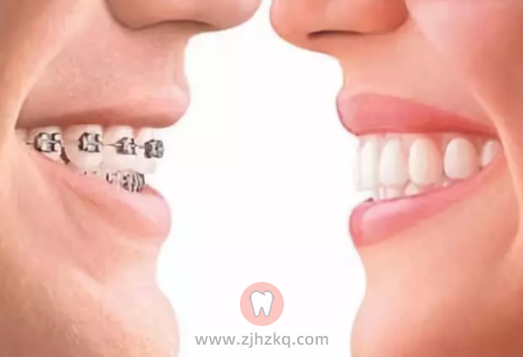 牙齿矫正十大优点