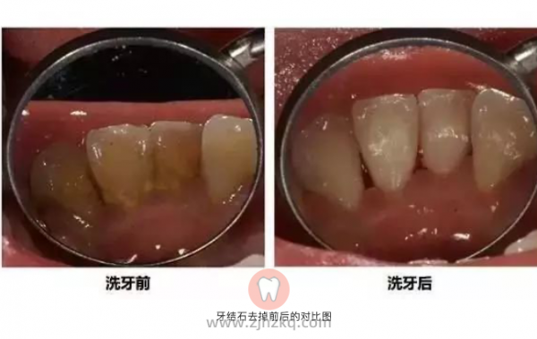 洗牙后牙缝变宽牙齿松动