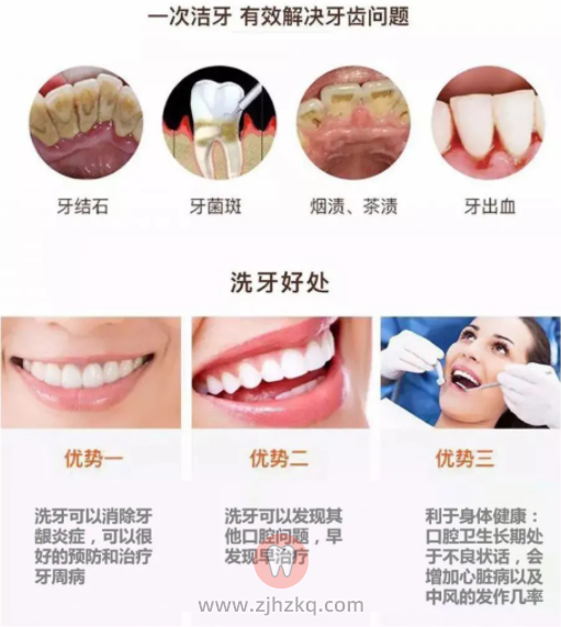 洗牙的好处有哪些？