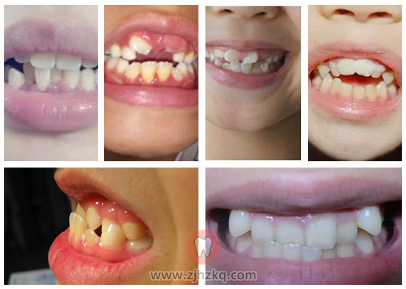 儿童牙齿不齐真实照片