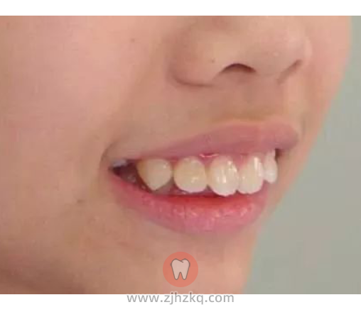 儿童龅牙照片图片