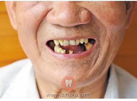 老年人缺牙危害有哪些？