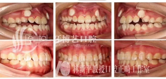杭州暑期各口腔医院的正畸促销优惠靠谱吗？