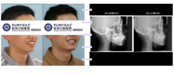 杭州口腔医院城西院区正畸案例牙颌面畸形