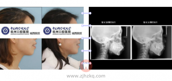 杭州口腔医院城西院区正畸案例骨性II类