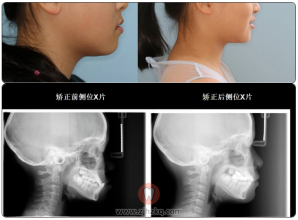 杭州口腔医院城西院区正畸案例地包天