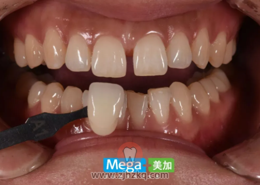 杭州瓷贴面牙齿贴面靠谱吗？