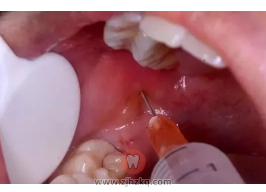 拔牙打麻药伤大脑