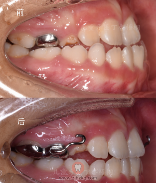 儿童牙医丁香梧桐儿童正畸案例