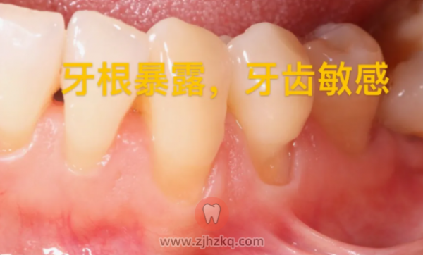 浙大口腔丁佩惠：牙龈退缩可以考虑手术修复