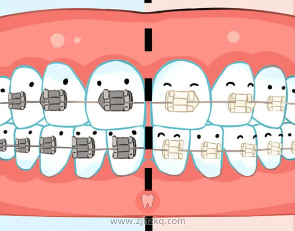 单晶托槽牙套和陶瓷托槽牙套区别