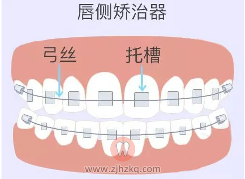 正畸牙套矫正的原理是什么？