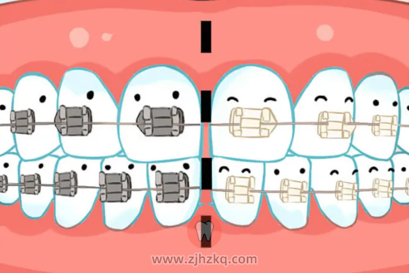 什么是陶瓷托槽牙套？