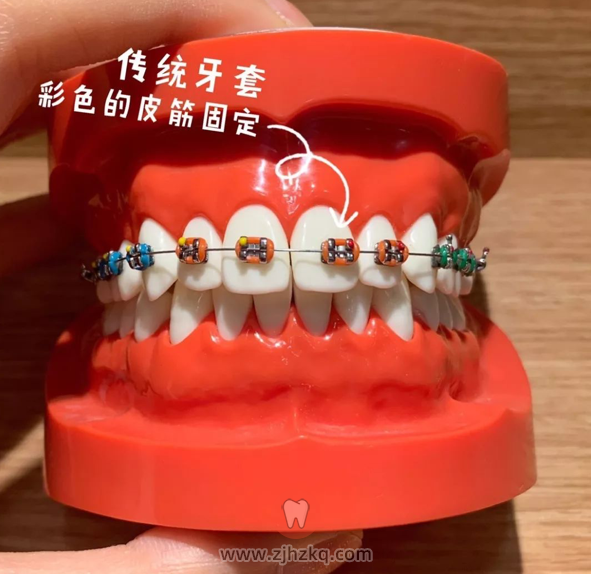 金属非自锁托槽矫正牙套图片