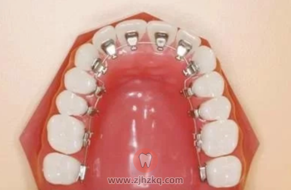 舌侧矫正牙套图片