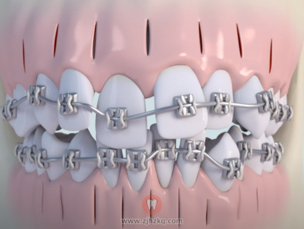 PAOO正畸植骨手术是什么？