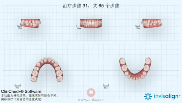 隐形矫正透明牙套一般戴多少副？