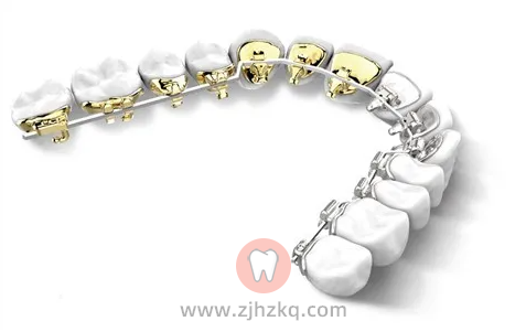 ebrace舌侧矫正器大概需要多少钱