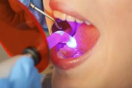 有了蛀牙该怎么办？