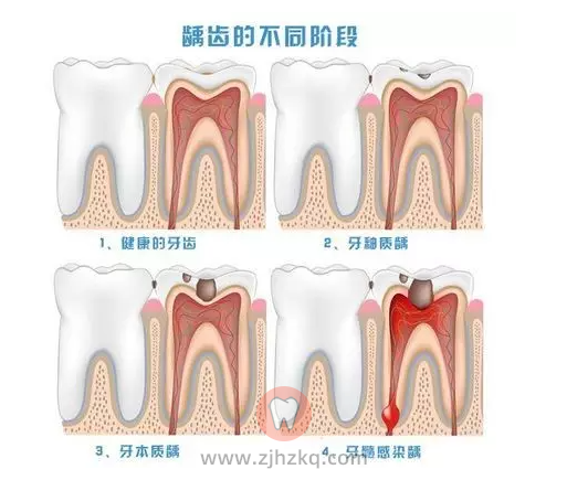 为什么会得蛀牙龋齿？
