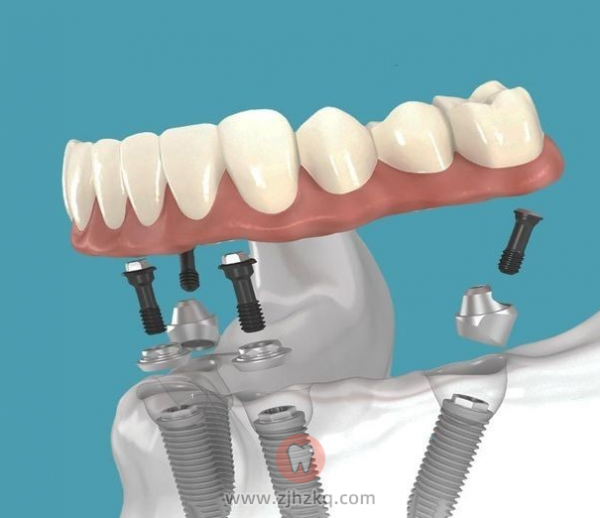 杭州种植牙的费用包括哪些？