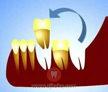 什么是自体牙移植术？