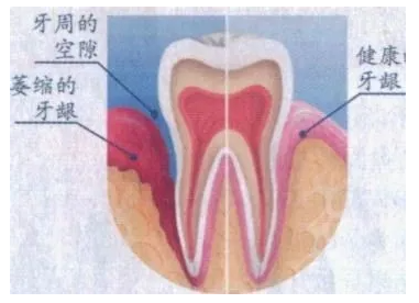什么是牙龈萎缩
