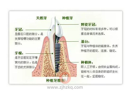 杭州种植牙哪里好哪家医院好？
