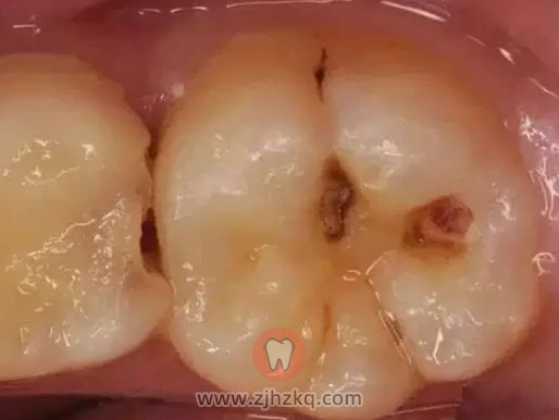 牙医告诫说:"病变已经破坏到了牙本质深层,牙齿有较深的龋洞,温度刺激